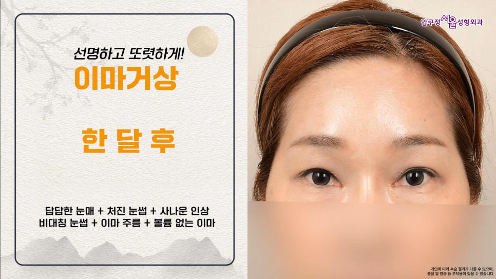 40대 이마거상수술 전후 궁금하다면? 내시경 이마거상술 체크포인트 관련 이미지 5