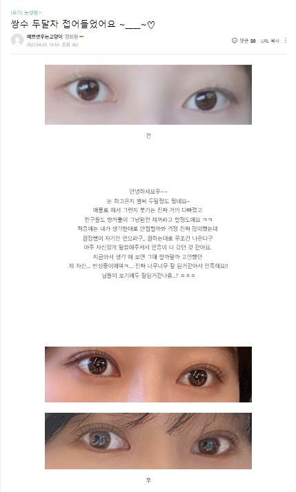Lovely Eyes Are No Longer Difficult! [Apgujeong Seoul Plastic Surgery] image 6