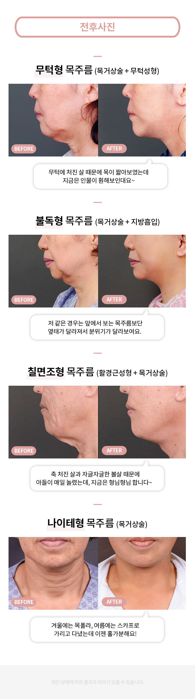 압구정성형외과 목주름 관련 이미지 2