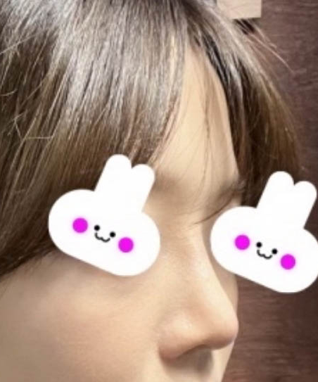 Apgujeong Bulbous Nose and Straight-Bridge Line Rhinoplasty Review image 4