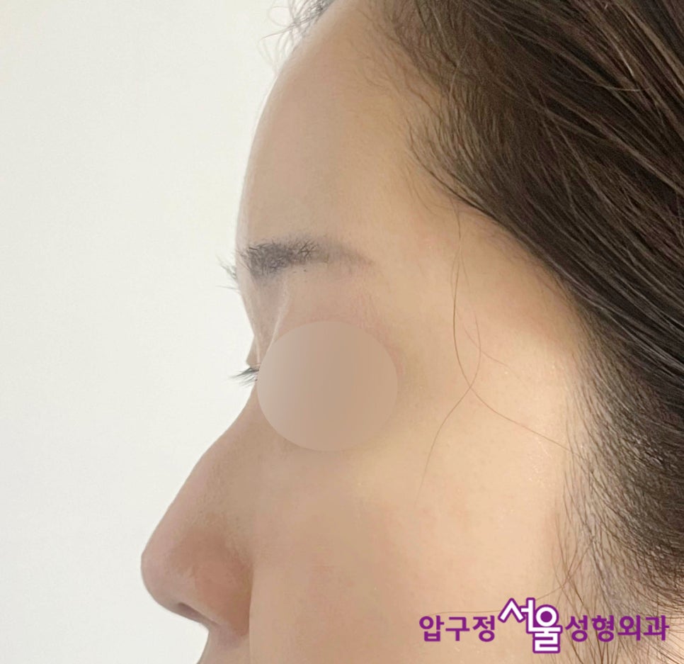 압구정 무보형물 코수술로 효과보는 매부리코 유형 관련 이미지 5
