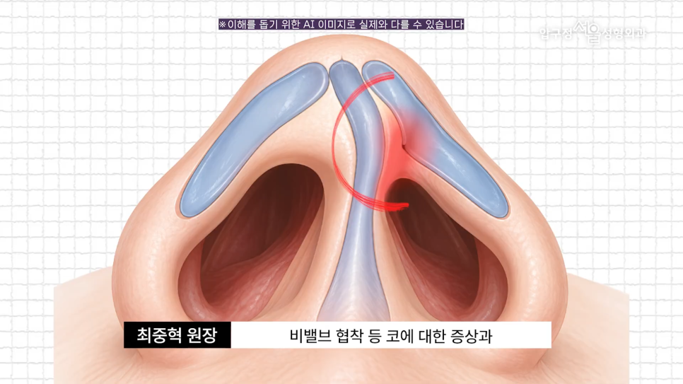 기능코수술 압구정서울성형외과 코막힘과 코 모양을 함께 고려한다면 관련 이미지 5