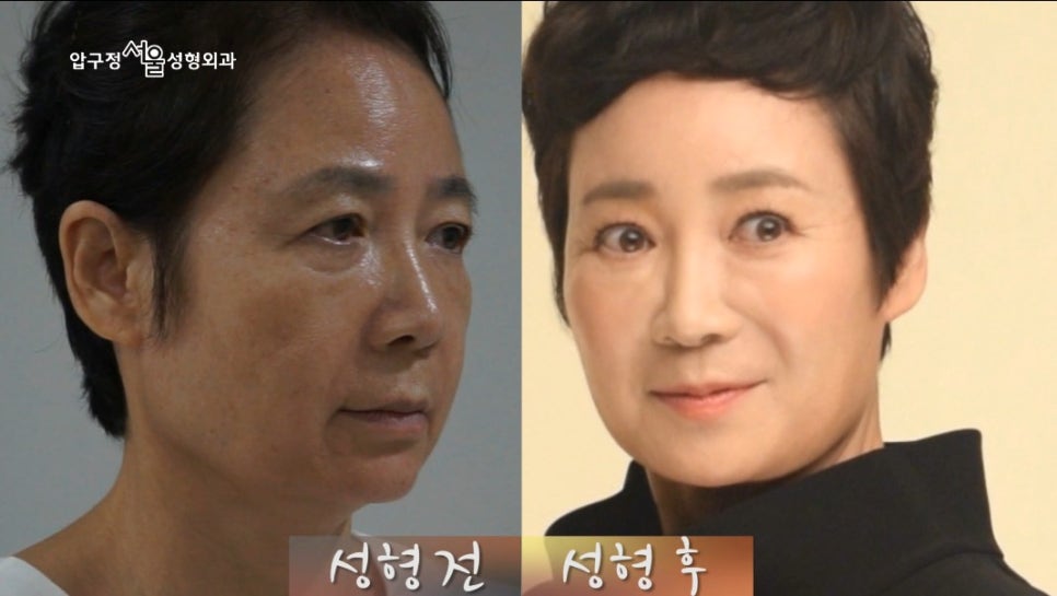 10년전으로 돌아간 60대 엄마의 성형 고백! 관련 이미지 5