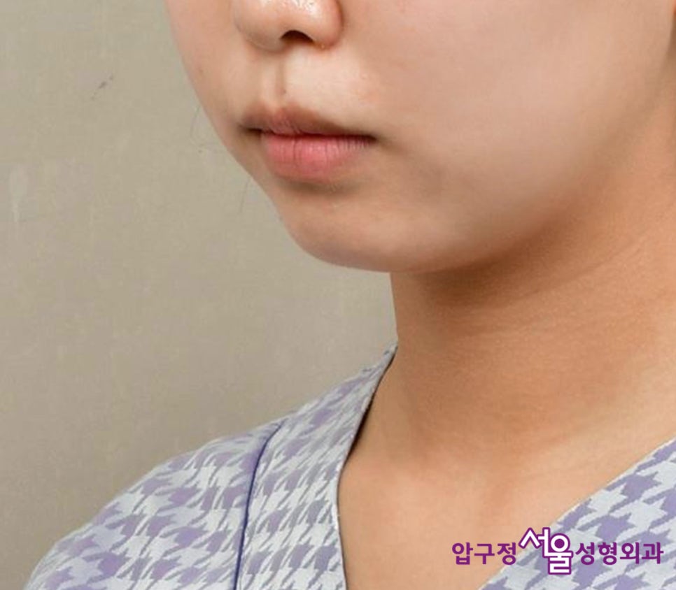 Chin Implant Surgery, a More Definitive Effect Than Fillers image 3
