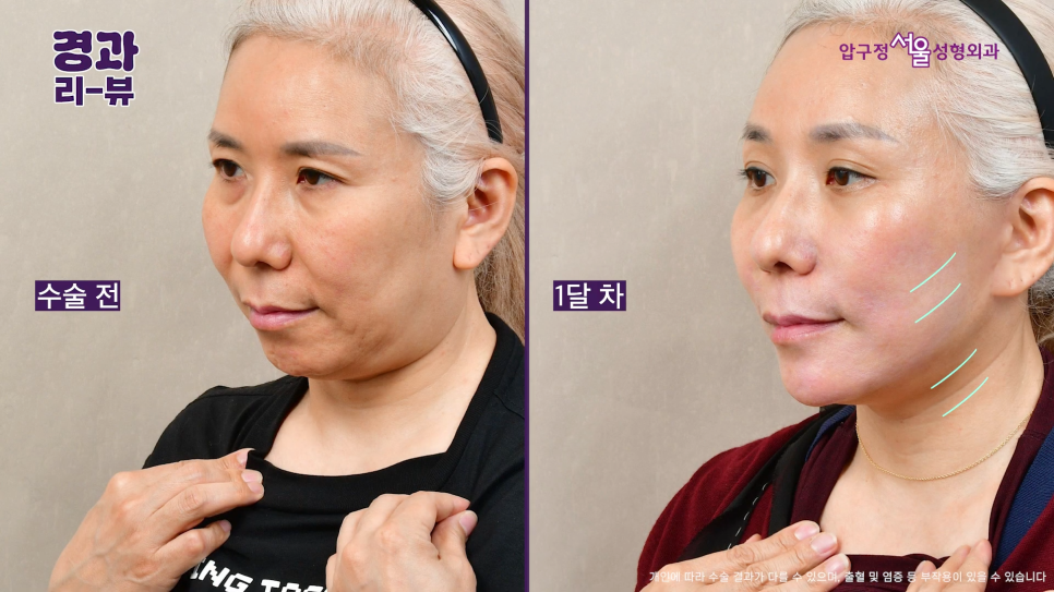 안면거상 전후 후기 압구정서울성형외과 실제 케이스 비교 분석 관련 이미지 6
