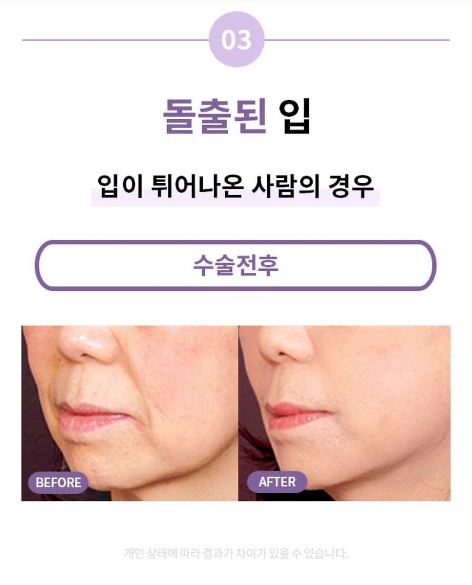 "SMAS Facelift" to Firmly Restore Sagging Jowls and Nasolabial Folds image 7