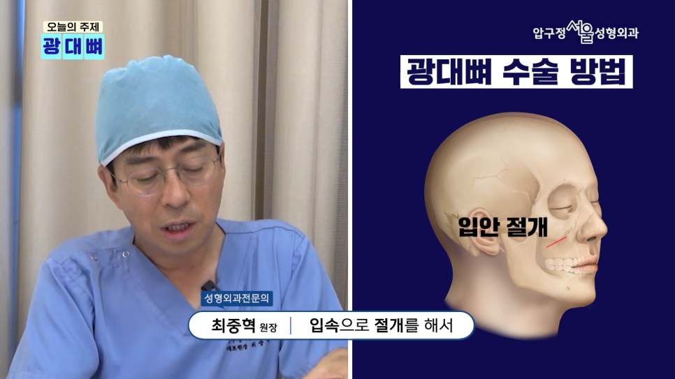 Types of Zygoma Reduction Surgery, Contour Surgery That Can Correct a Peanut-Shaped Face | Apgujeong Seoul Plastic Surgery image 4