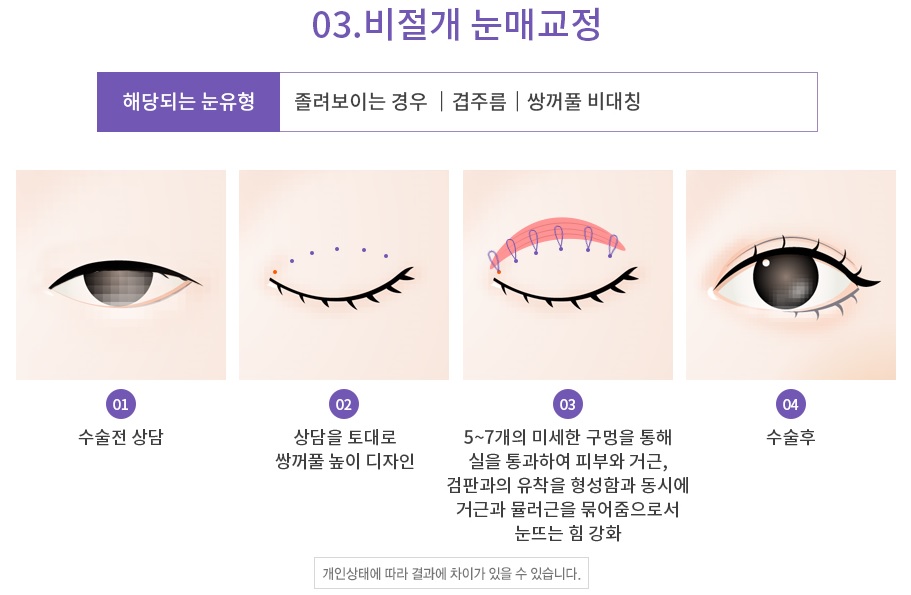 Apgujeong Seoul Plastic Surgery: Revision Eyelid Surgery Methods and Reviews by Type image 5