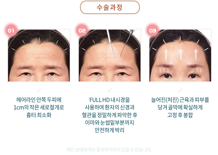 Anti-Aging at Apgujeong Seoul Plastic Surgery > Endoscopic Forehead Lift image 3