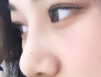 Customized Surgery by Nose Surgery Type, Fast Recovery, and a Good Place for Revision Rhinoplasty: Apgujeong Seoul Plastic Surgery image 5