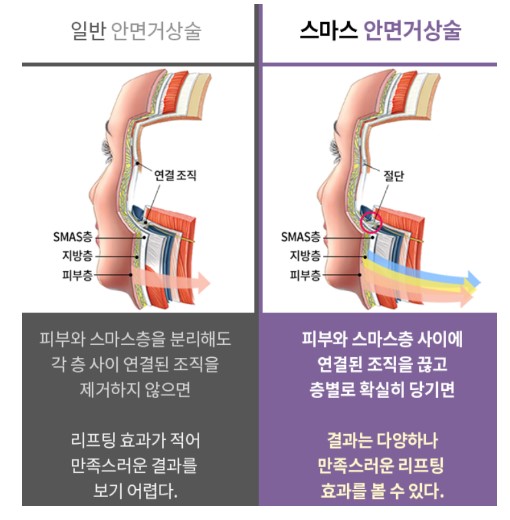Seoul Plastic Surgery Recommendation: Still Debating It? image 5