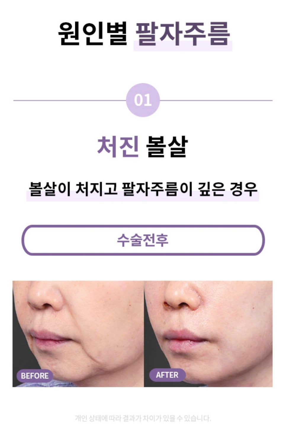 "SMAS Facelift" to Firmly Restore Sagging Jowls and Nasolabial Folds image 5
