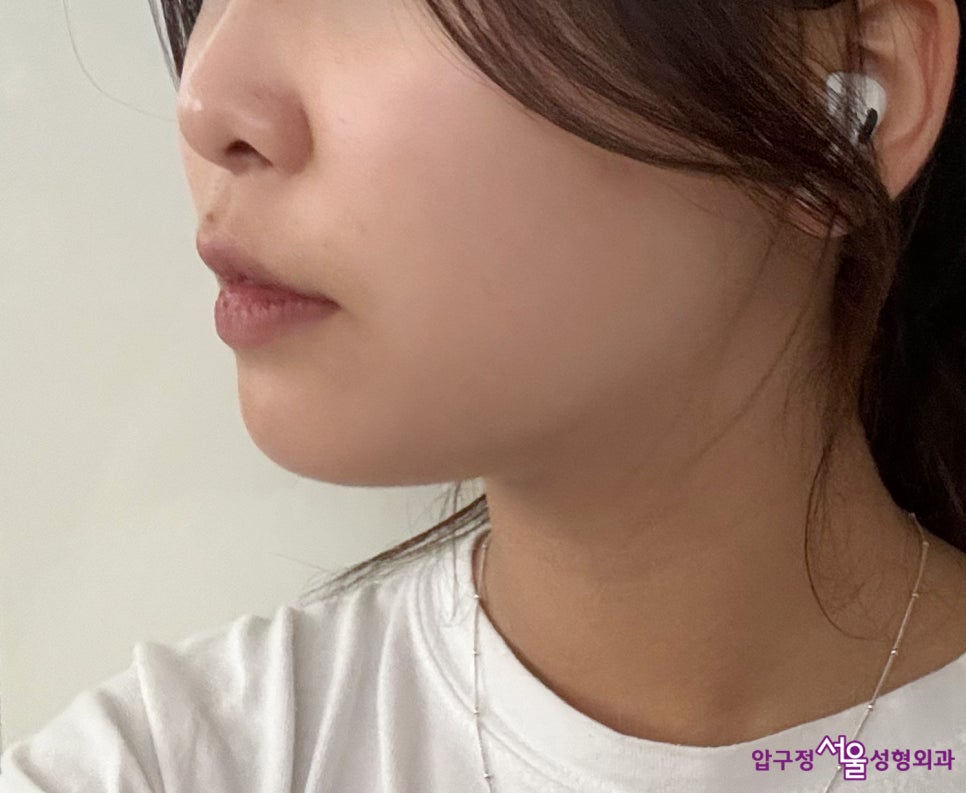 Chin Implant Surgery, a More Definitive Effect Than Fillers image 6