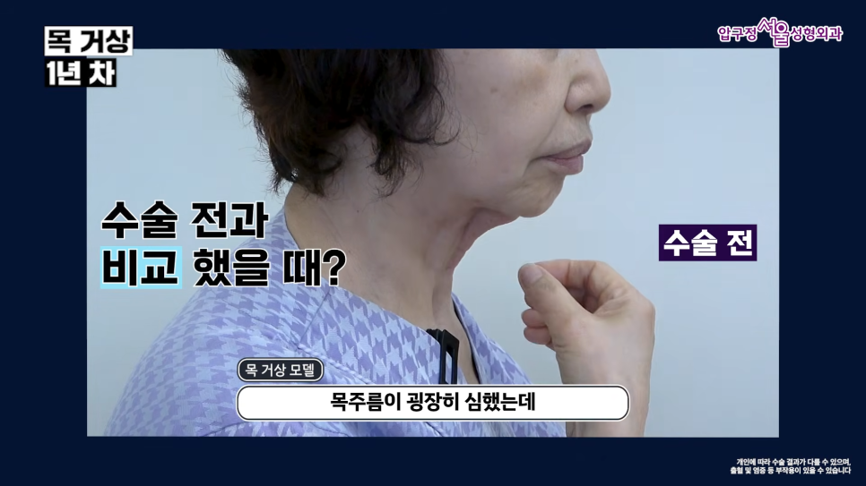 목거상 흉터 후기 목주름 수술 1년 후 변화 압구정서울성형외과 실제 사례로 알아보기 관련 이미지 9