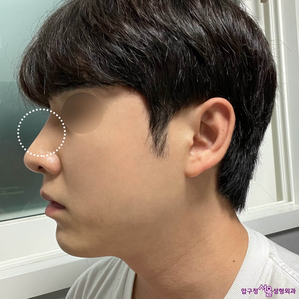 Apgujeong Seoul Plastic Surgery: Review of a Man’s Hump Nose and Bulbous Nose Surgery image 5