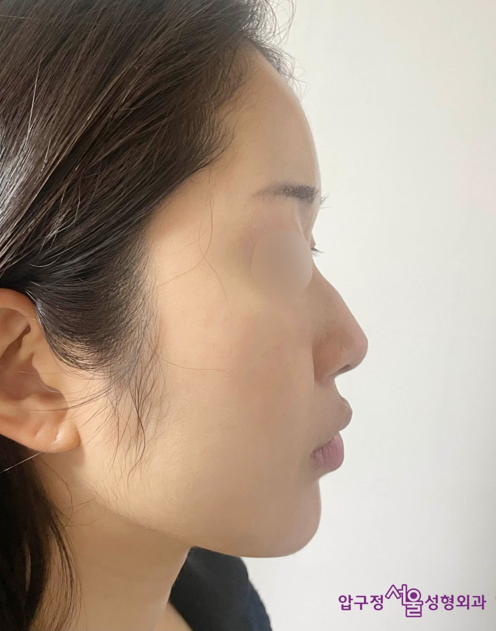 Natural Rhinoplasty Review for a Hump Nose with Septal Deviation in Apgujeong image 1