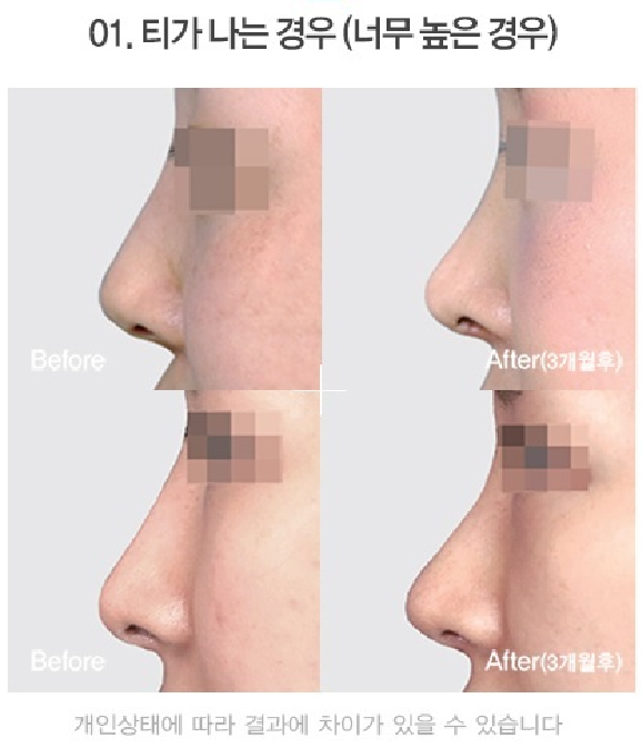 Apgujeong Seoul Plastic Surgery: Revision Rhinoplasty Methods by Type and Reviews image 4