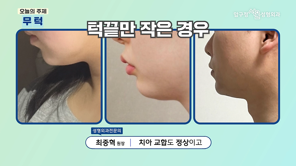 What Is a Retruded Chin? Chin Implant Surgery for Chin Correction at Apgujeong Seoul Plastic Surgery image 1