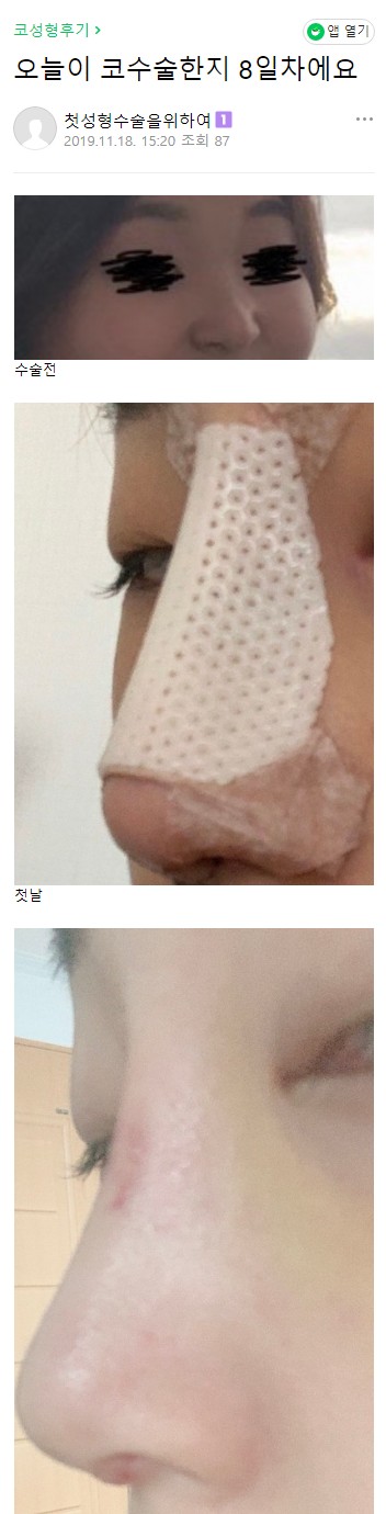 Escape from a Low Nasal Bridge at Apgujeong Seoul Plastic Surgery! image 4
