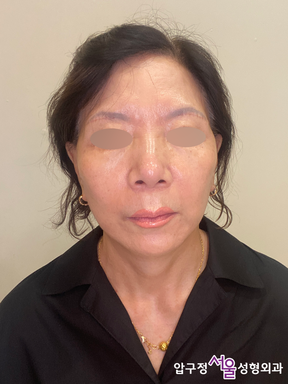 Curious About Reviews of a Clinic That Does Facelift Surgery Well at Apgujeong Seoul Plastic Surgery? image 6
