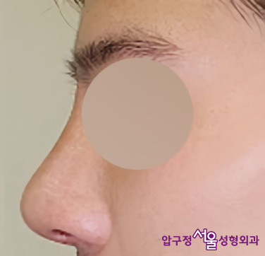 Apgujeong Plastic Surgery Nose Revision: Upturned Nose Causes and Surgery Review image 8