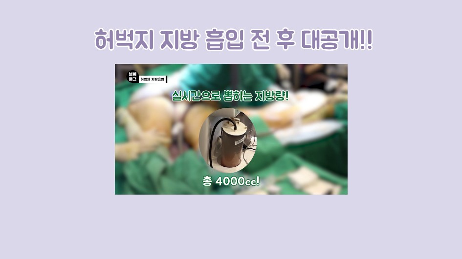 압구정서울성형외과 - 지방흡입 과정 브이로그 대공개 1탄! 관련 이미지 1
