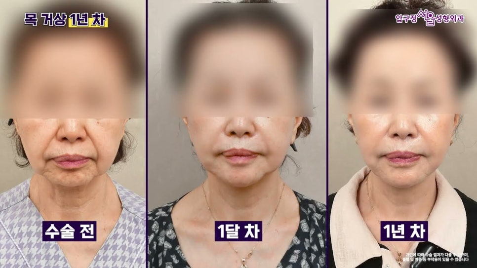 목거상 흉터 후기 목주름 수술 1년 후 변화 압구정서울성형외과 실제 사례로 알아보기 관련 이미지 1