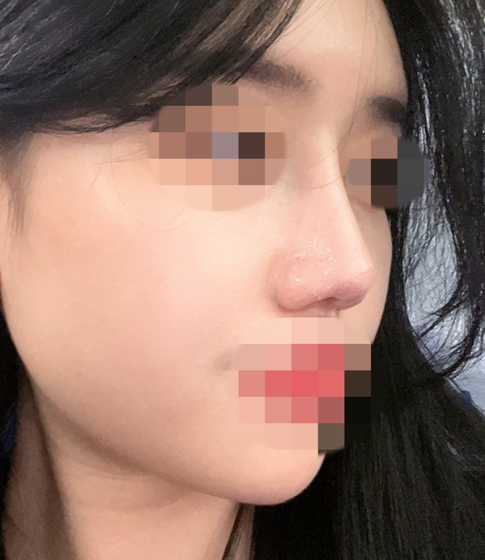 압구정서울성형외과 설윤 직선라인 자려한코성형 최중혁원장님 관련 이미지 8