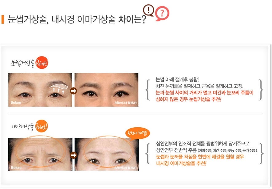 압구정 이마거상 여자 이마거상 효과 내시경이마거상술 전후 사례 이마주름 원인 관련 이미지 5
