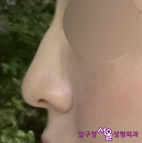 Apgujeong Seoul Plastic Surgery: The Effect of Nasolabial Angle Rhinoplasty (Shin Se-kyung, Minji) image 4