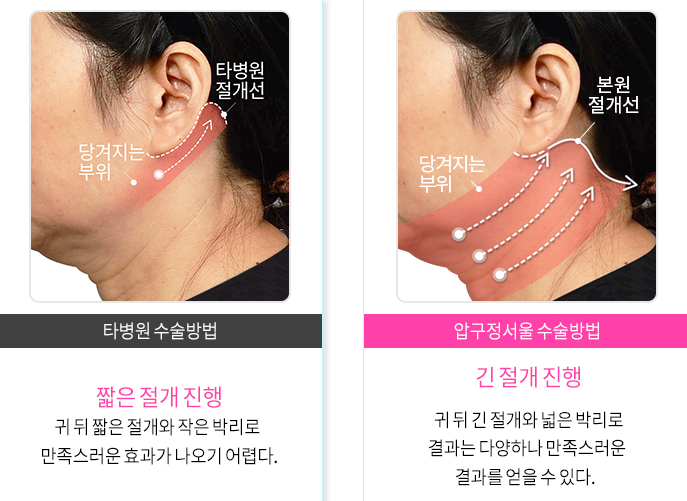 [압구정서울성형외과] 목주름과 처짐 목거상으로 깔끔한 개선! 관련 이미지 3