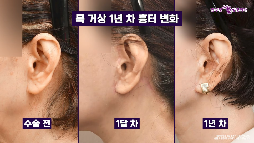 목거상 흉터 후기 목주름 수술 1년 후 변화 압구정서울성형외과 실제 사례로 알아보기 관련 이미지 11