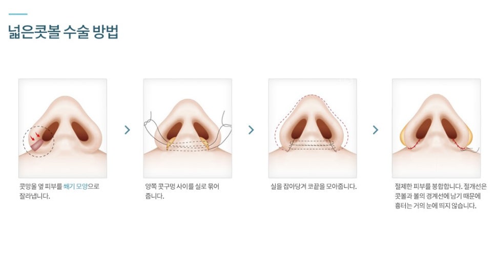 Apgujeong Bulbous Nose and Straight-Bridge Line Rhinoplasty Review image 6