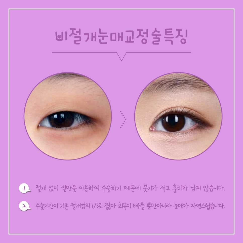 흉터 없이 크고 시원한 눈매를 만드는 비절개 눈매교정 관련 이미지 3