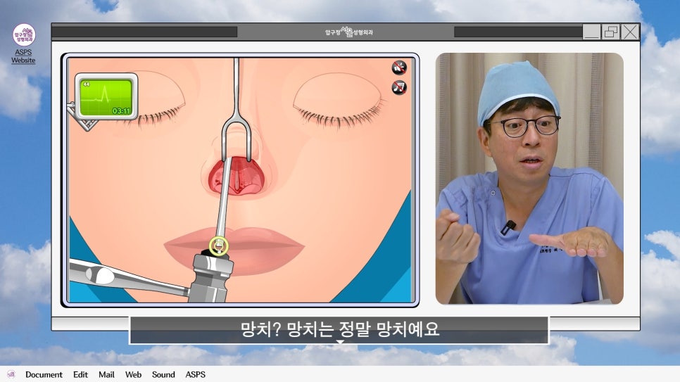 매부리코 코수술 게임 후기 및 비중격연골 매부리 코수술 방법 코수술 진행 과정 압구정서울성형외과 관련 이미지 14