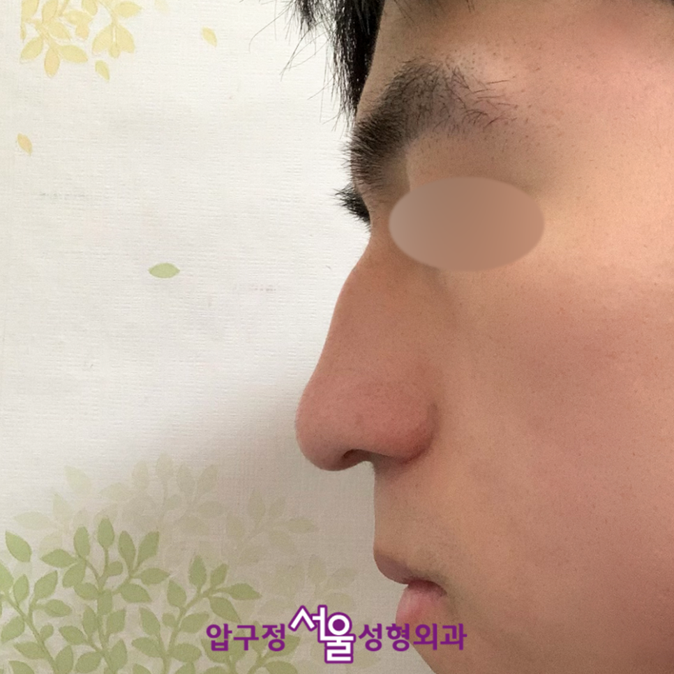압구정서울성형외과의원 박보검 코 남자 연예인 같은 매부리코 수술 사례 관련 이미지 7