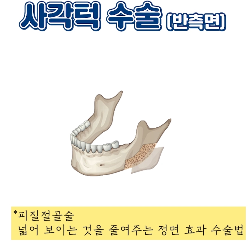 압구정 안면윤곽 사각턱, 광대, 턱끝 개념과 종류 수술방법 압구정서울성형외과 관련 이미지 18