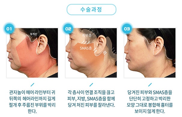 Before-and-After of Facelift and Neck Lift Surgery in Apgujeong: SMAS Facelift Case at Apgujeong Seoul Plastic Surgery image 5