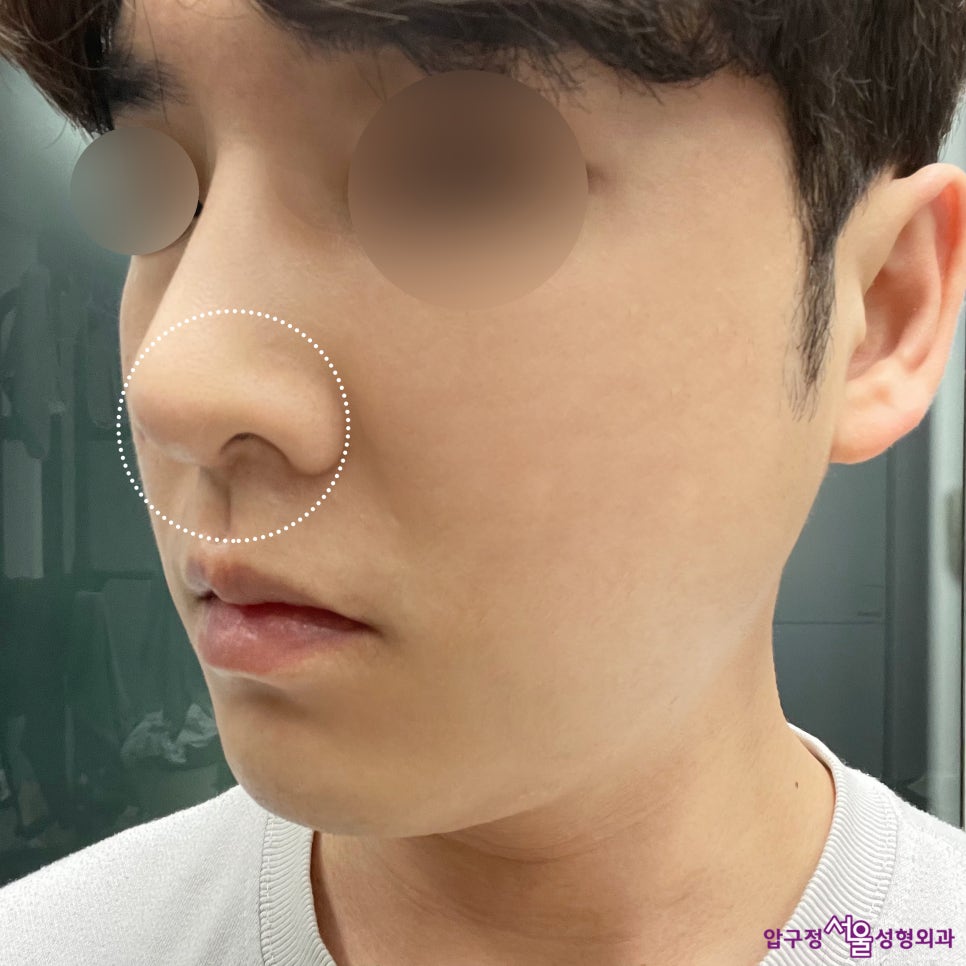 Apgujeong Seoul Plastic Surgery: Review of a Man’s Hump Nose and Bulbous Nose Surgery image 6