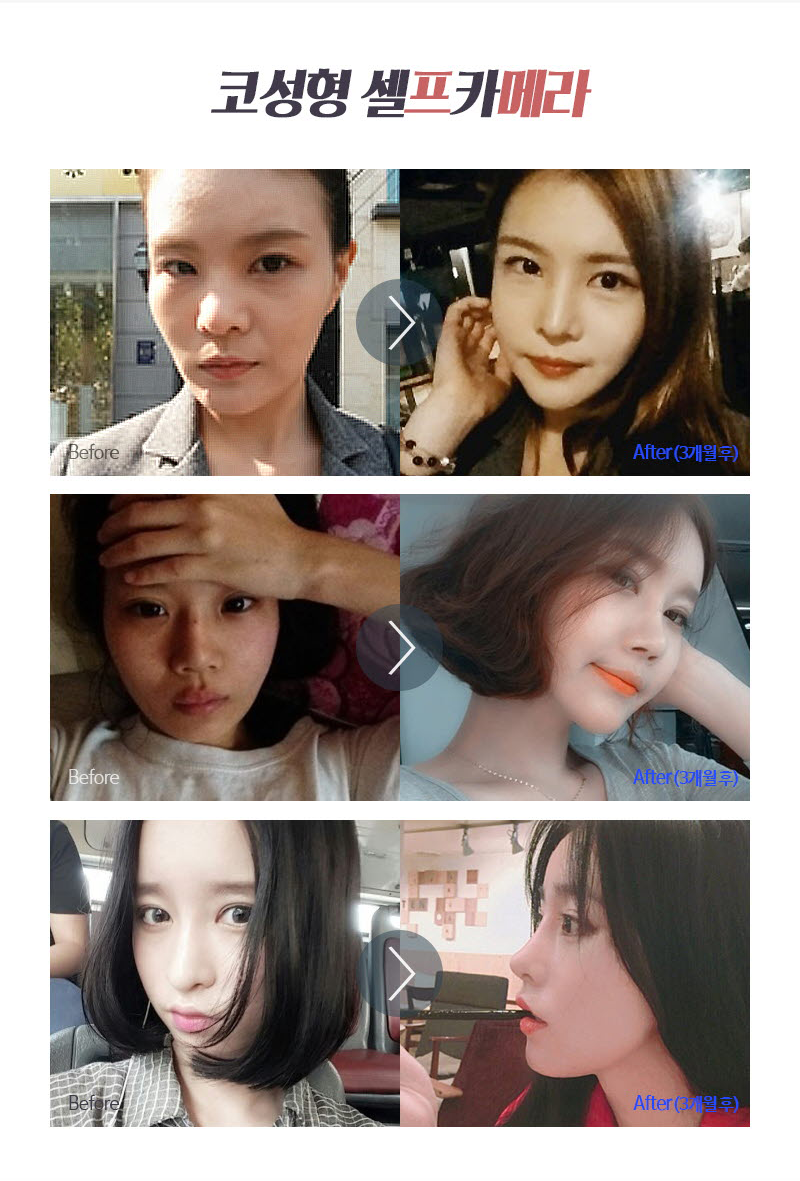 눈 성형보다 코 성형 회복이 훨씬 빠르다는 사실! 관련 이미지 8