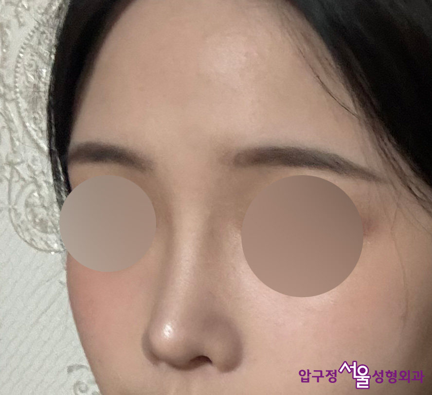 압구정서울성형외과 수험생 낮은코, 복코성형 후기 관련 이미지 3
