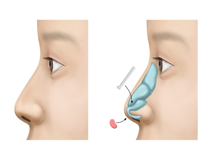 Apgujeong Seoul Plastic Surgery: The Effect of Nasolabial Angle Rhinoplasty (Shin Se-kyung, Minji) image 1