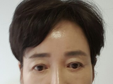 A Dramatic Transformation for Brighter, Clearer Eyes: A 5-Year Follow-Up Review of Forehead Lift Surgery in Your 60s image 8