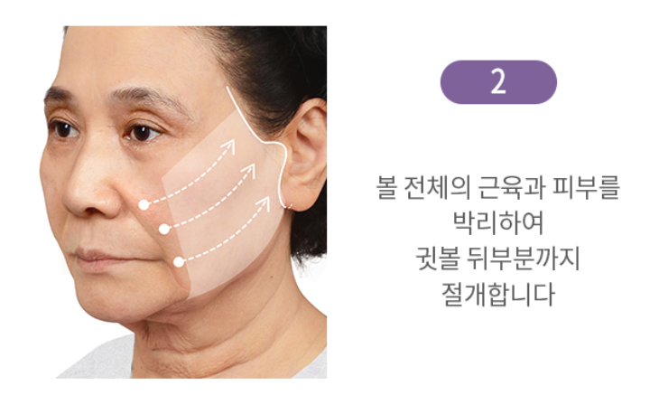 "SMAS Facelift" to Firmly Restore Sagging Jowls and Nasolabial Folds image 12