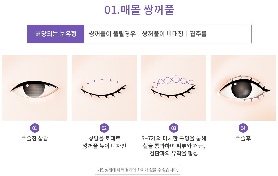 Apgujeong Seoul Plastic Surgery: Revision Eyelid Surgery Methods and Reviews by Type image 3