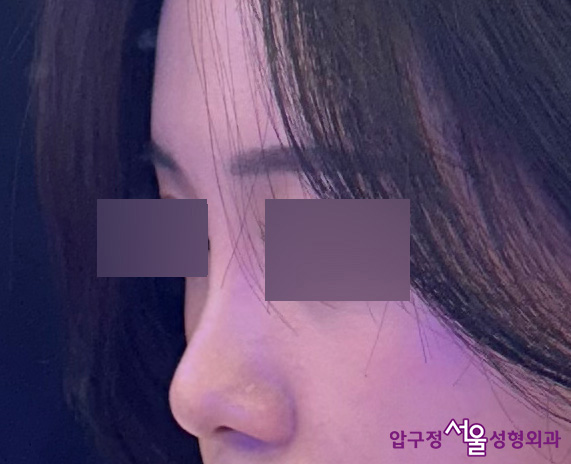 When Can Minors Preparing for College Entrance Exams Get Eye Surgery or Nose Surgery? image 11