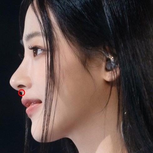 Apgujeong Seoul Plastic Surgery: The Effect of Nasolabial Angle Rhinoplasty (Shin Se-kyung, Minji) image 2