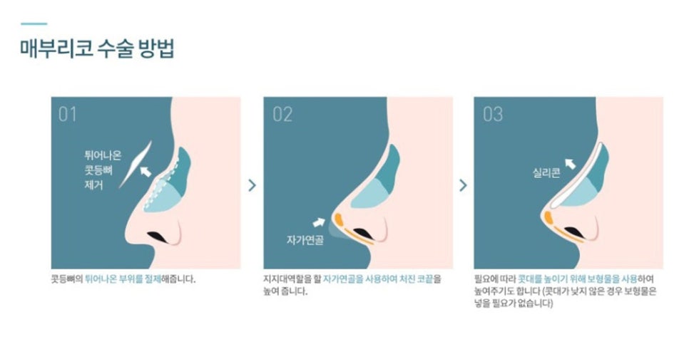 Apgujeong Plastic Surgery Review: Improved Hump Nose with a Straight Nose Line image 2