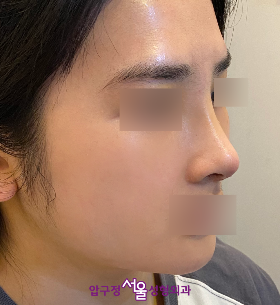 김유정 코, 눈수술(직반라인, 인아웃라인 쌍꺼풀) 연예인과 비슷하게 압구정서울성형외과 관련 이미지 9