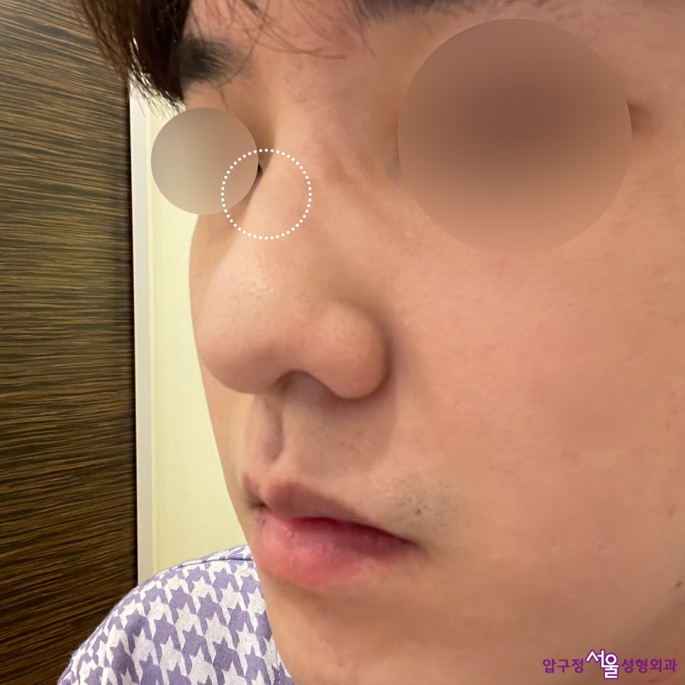 Apgujeong Seoul Plastic Surgery: Review of a Man’s Hump Nose and Bulbous Nose Surgery image 3